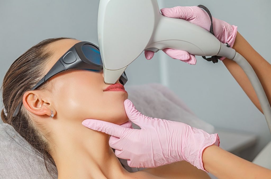 laser hair removal